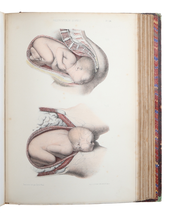 Atlas de L'Art des Accouchements. Continué par Marc Sée (et) S. Tavernier. Ouvrage contenant 105 Planches avec Texte Explicatif en Regard.