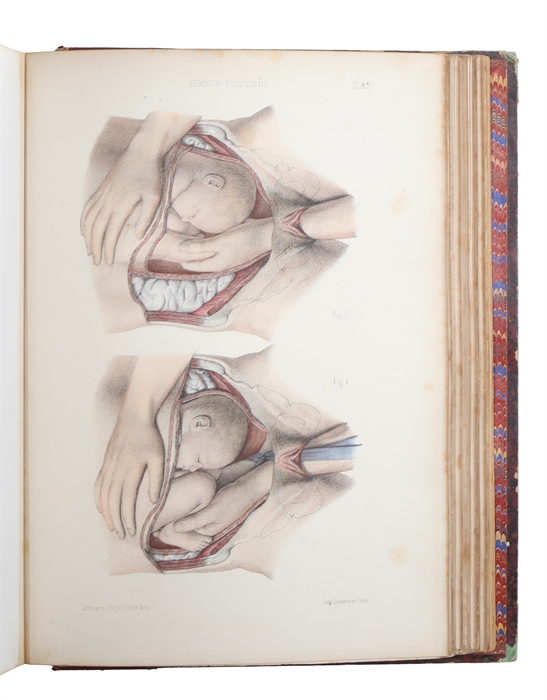 Atlas de L'Art des Accouchements. Continué par Marc Sée (et) S. Tavernier. Ouvrage contenant 105 Planches avec Texte Explicatif en Regard.