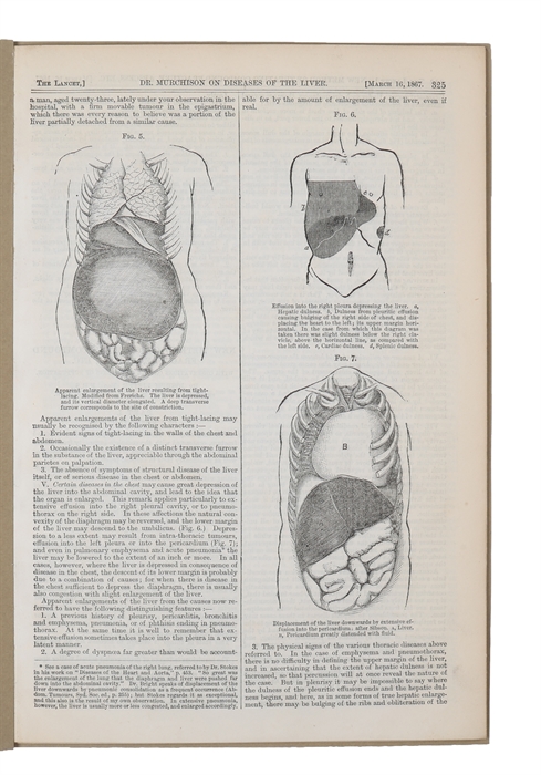 A New Method of Treating Compound Fracture, Abscess, etc. With Observations on the Conditions of Suppuration. Part I. On Compound Fracture - Part I (continued) - Part I (continued) - Part I (continued) - (Part II) New Method of Treating Compound Fract...